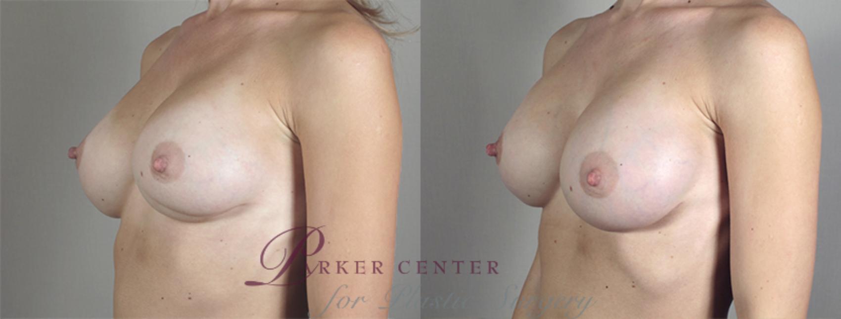 Breast Implant Revision Case 585 Before & After View #2 | Paramus, New Jersey | Parker Center for Plastic Surgery