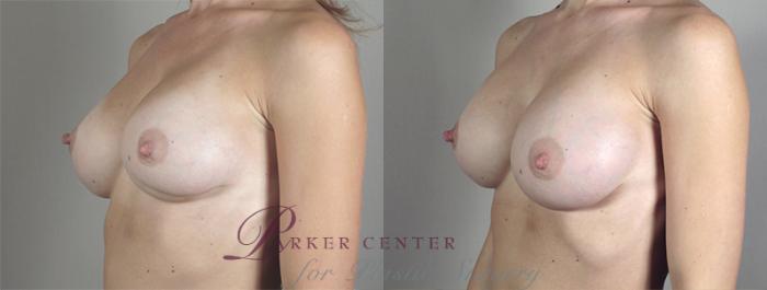 Breast Implant Revision Case 585 Before & After View #2 | Paramus, NJ | Parker Center for Plastic Surgery