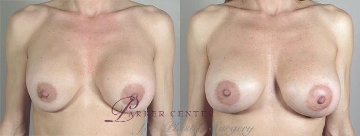 Breast Implant Revision Case 586 Before & After View #1 | Paramus, NJ | Parker Center for Plastic Surgery
