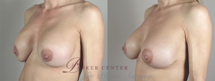 Breast Implant Revision Case 586 Before & After View #2 | Paramus, NJ | Parker Center for Plastic Surgery