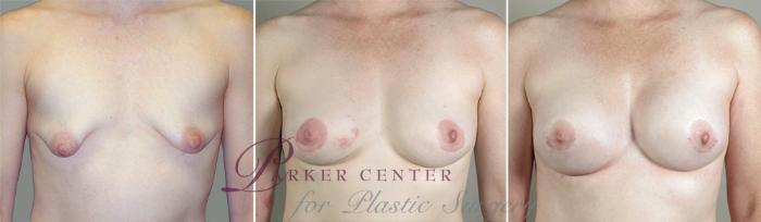 Breast Implant Revision Case 587 Before & After View #1 | Paramus, NJ | Parker Center for Plastic Surgery