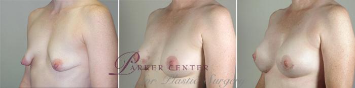 Breast Implant Revision Case 587 Before & After View #2 | Paramus, NJ | Parker Center for Plastic Surgery