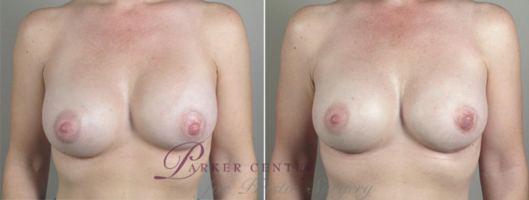 Breast Implant Revision Case 588 Before & After View #1 | Paramus, NJ | Parker Center for Plastic Surgery
