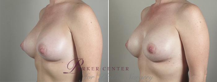 Breast Implant Revision Case 588 Before & After View #2 | Paramus, NJ | Parker Center for Plastic Surgery