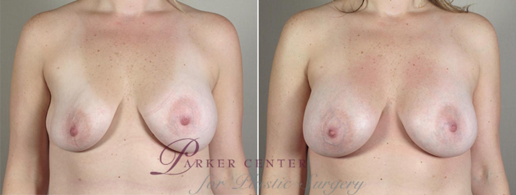 Breast Implant Revision Case 589 Before & After View #1 | Paramus, NJ | Parker Center for Plastic Surgery