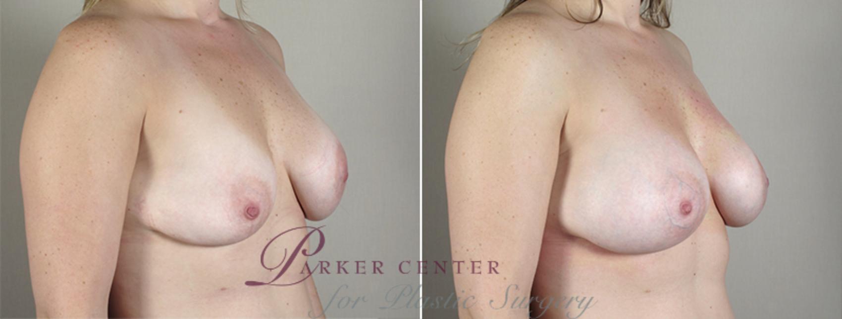 Breast Implant Revision Case 589 Before & After View #2 | Paramus, New Jersey | Parker Center for Plastic Surgery