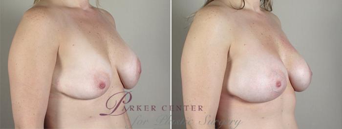Breast Implant Revision Case 589 Before & After View #2 | Paramus, NJ | Parker Center for Plastic Surgery