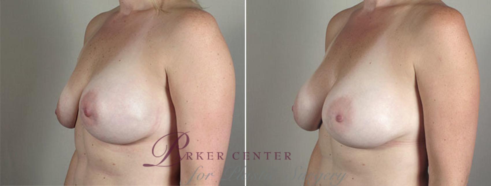 Breast Implant Revision Case 589 Before & After View #3 | Paramus, New Jersey | Parker Center for Plastic Surgery