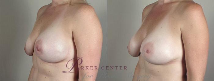 Breast Implant Revision Case 589 Before & After View #3 | Paramus, NJ | Parker Center for Plastic Surgery