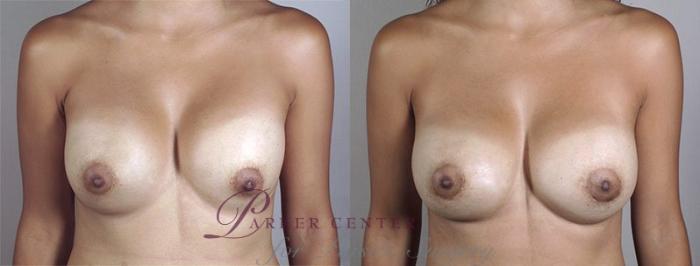 Breast Implant Revision Case 590 Before & After View #1 | Paramus, NJ | Parker Center for Plastic Surgery
