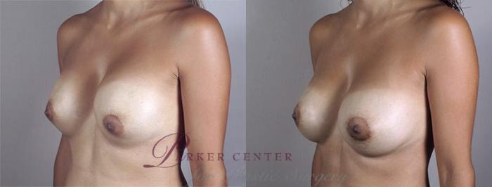 Breast Implant Revision Case 590 Before & After View #2 | Paramus, NJ | Parker Center for Plastic Surgery
