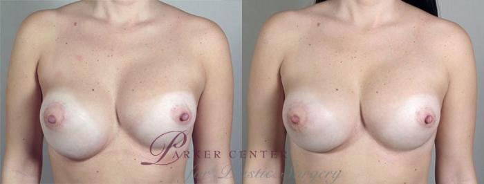 Breast Implant Revision Case 591 Before & After View #1 | Paramus, NJ | Parker Center for Plastic Surgery