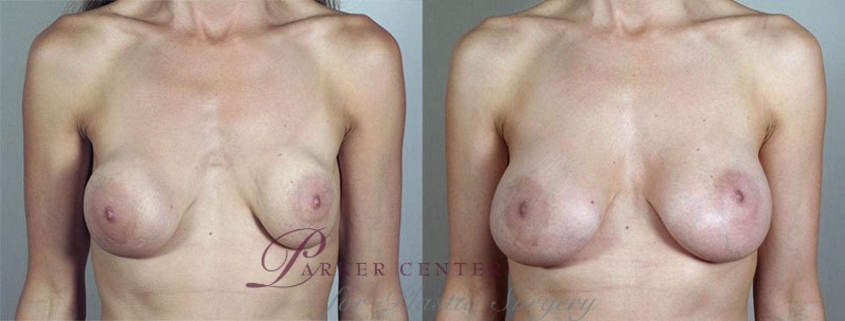 Breast Implant Revision Case 592 Before & After View #1 | Paramus, NJ | Parker Center for Plastic Surgery