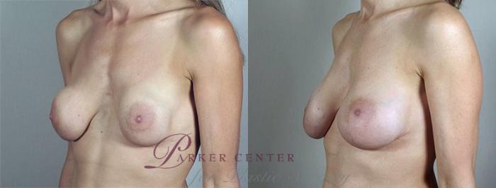Breast Implant Revision Case 592 Before & After View #2 | Paramus, NJ | Parker Center for Plastic Surgery
