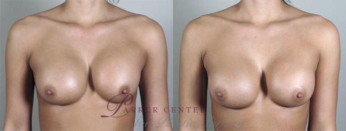 Breast Implant Revision Case 593 Before & After View #1 | Paramus, NJ | Parker Center for Plastic Surgery