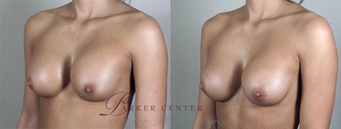 Breast Implant Revision Case 593 Before & After View #2 | Paramus, NJ | Parker Center for Plastic Surgery