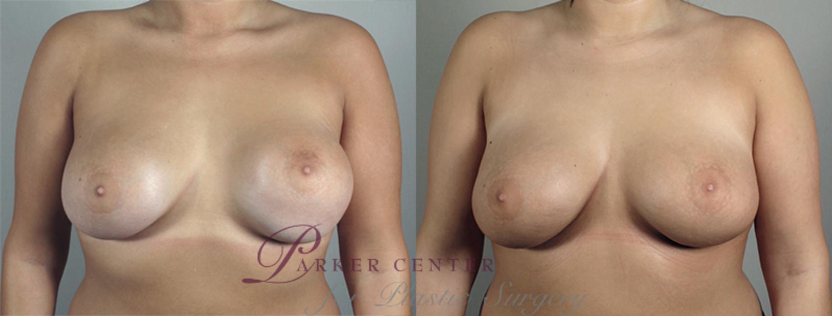 Breast Implant Revision Case 595 Before & After View #1 | Paramus, NJ | Parker Center for Plastic Surgery