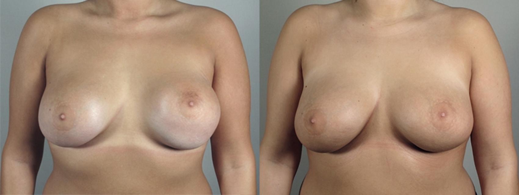 Breast Implant Revision Case 595 Before & After View #1 | Paramus, NJ | Parker Center for Plastic Surgery