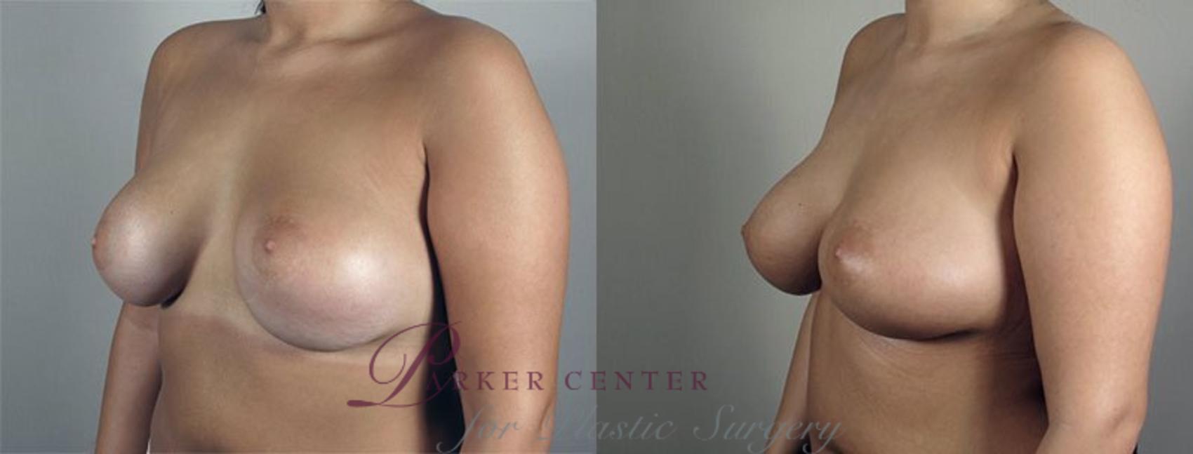 Breast Implant Revision Case 595 Before & After View #2 | Paramus, NJ | Parker Center for Plastic Surgery