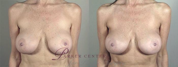 Breast Implant Revision Case 596 Before & After View #1 | Paramus, NJ | Parker Center for Plastic Surgery