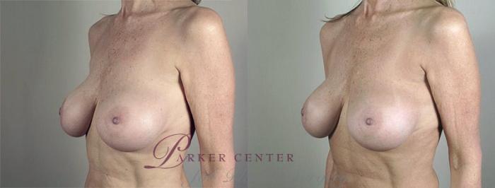 Breast Implant Revision Case 596 Before & After View #2 | Paramus, NJ | Parker Center for Plastic Surgery
