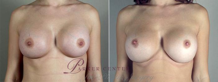 Breast Implant Revision Case 597 Before & After View #1 | Paramus, NJ | Parker Center for Plastic Surgery