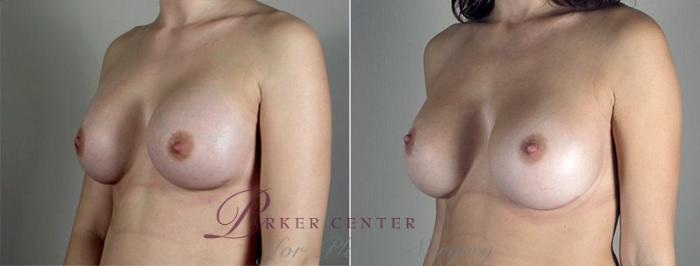 Breast Implant Revision Case 597 Before & After View #2 | Paramus, NJ | Parker Center for Plastic Surgery