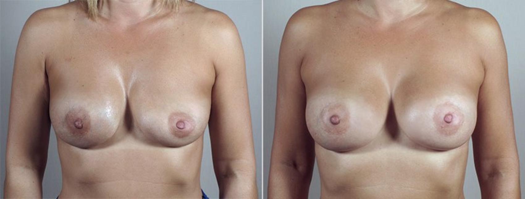 Breast Implant Revision Case 598 Before & After View #1 | Paramus, New Jersey | Parker Center for Plastic Surgery