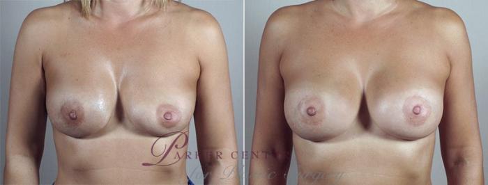 Breast Implant Revision Case 598 Before & After View #1 | Paramus, NJ | Parker Center for Plastic Surgery