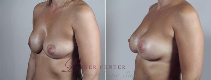 Breast Implant Revision Case 598 Before & After View #2 | Paramus, NJ | Parker Center for Plastic Surgery