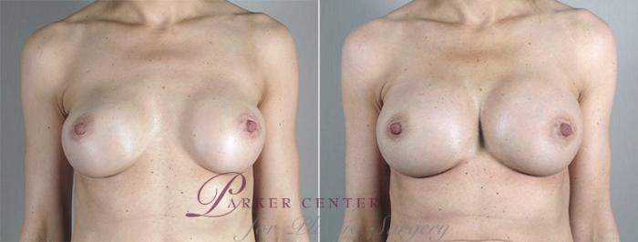 Breast Implant Revision Case 599 Before & After View #1 | Paramus, NJ | Parker Center for Plastic Surgery