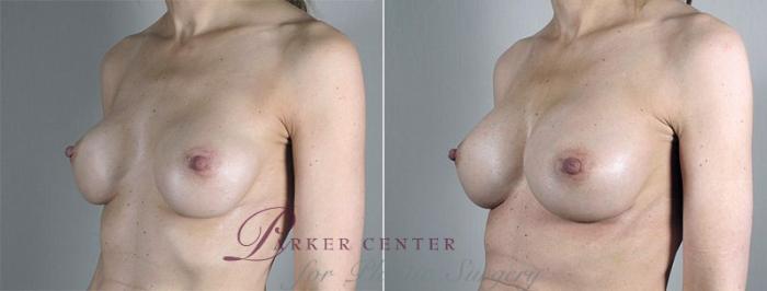 Breast Implant Revision Case 599 Before & After View #2 | Paramus, NJ | Parker Center for Plastic Surgery