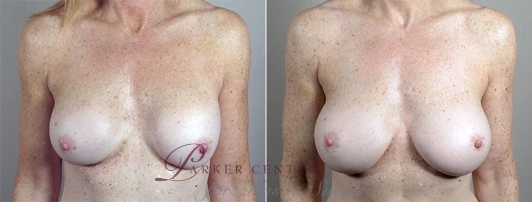 Breast Implant Revision Case 600 Before & After View #1 | Paramus, NJ | Parker Center for Plastic Surgery