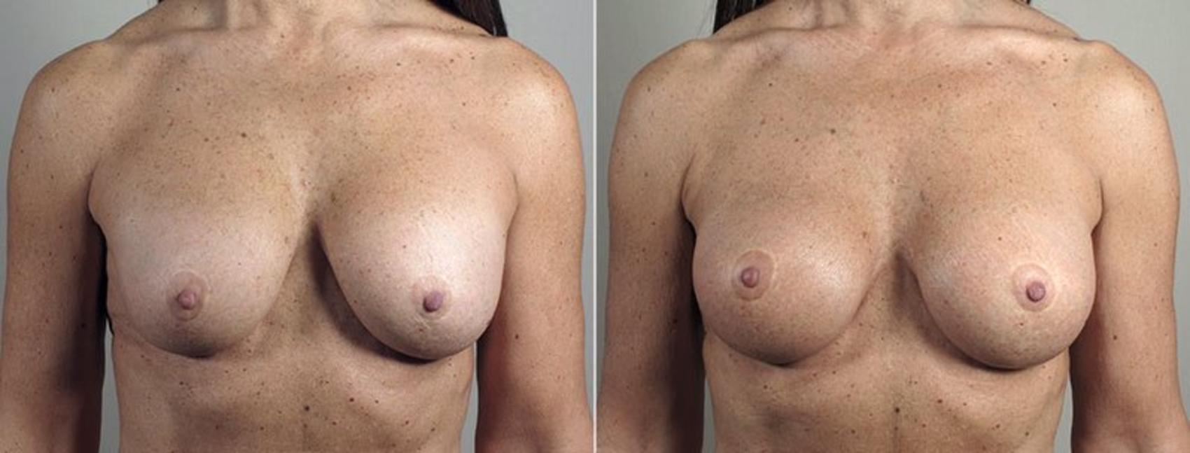 Breast Implant Revision Case 601 Before & After View #1 | Paramus, NJ | Parker Center for Plastic Surgery