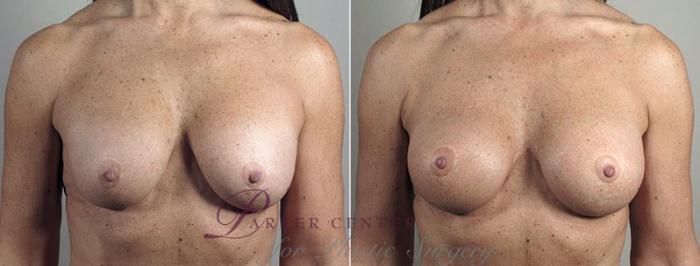 Breast Implant Revision Case 601 Before & After View #1 | Paramus, NJ | Parker Center for Plastic Surgery