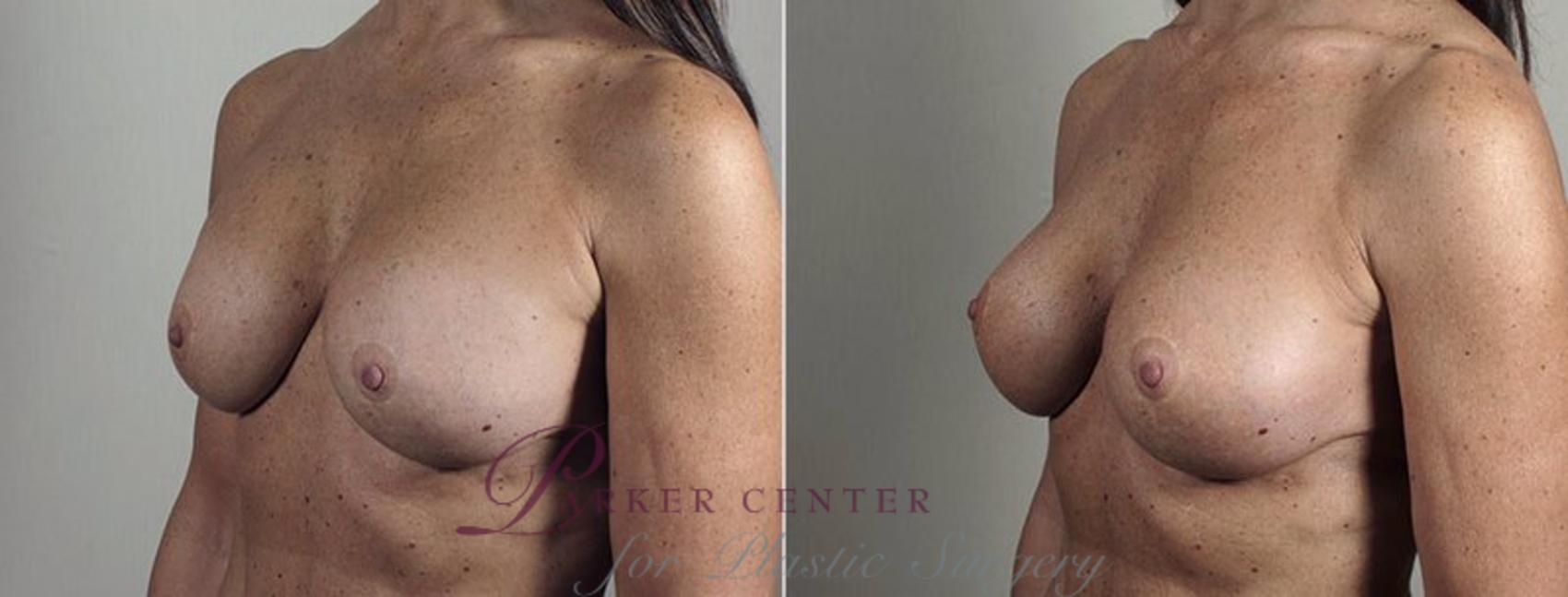 Breast Implant Revision Case 601 Before & After View #2 | Paramus, NJ | Parker Center for Plastic Surgery