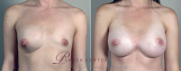 Breast Implant Revision Case 602 Before & After View #1 | Paramus, NJ | Parker Center for Plastic Surgery