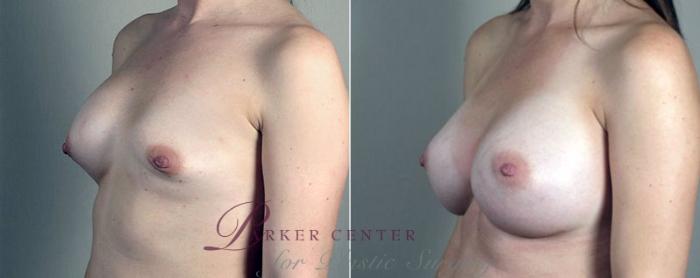 Breast Implant Revision Case 602 Before & After View #2 | Paramus, NJ | Parker Center for Plastic Surgery