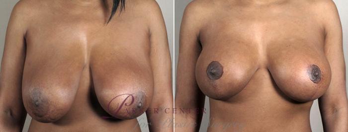 Breast Implant Revision Case 603 Before & After View #1 | Paramus, NJ | Parker Center for Plastic Surgery