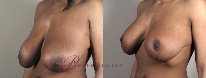 Breast Implant Revision Case 603 Before & After View #2 | Paramus, NJ | Parker Center for Plastic Surgery