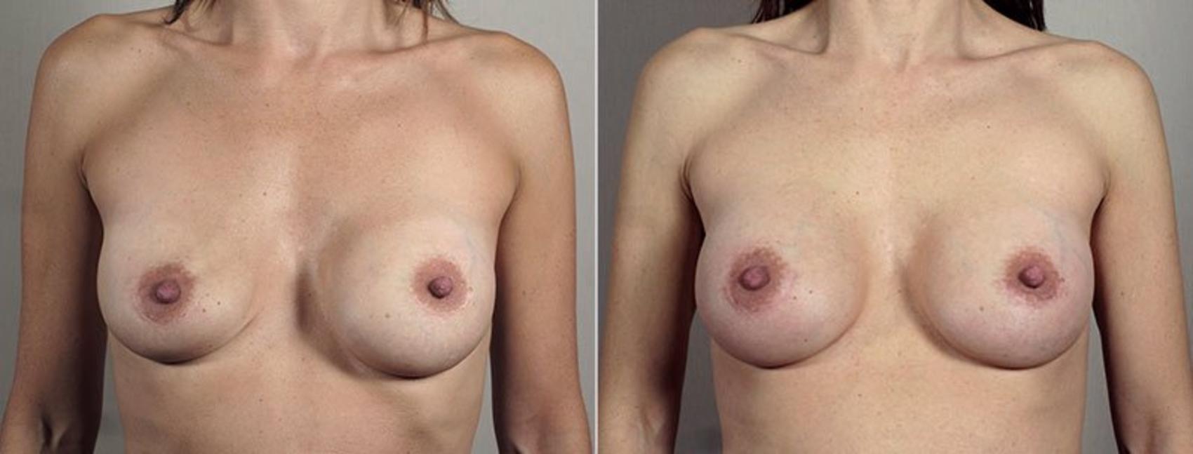 Breast Implant Revision Case 604 Before & After View #1 | Paramus, New Jersey | Parker Center for Plastic Surgery