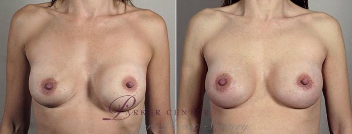 Breast Implant Revision Case 604 Before & After View #1 | Paramus, NJ | Parker Center for Plastic Surgery