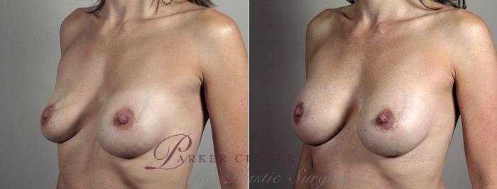 Breast Implant Revision Case 604 Before & After View #2 | Paramus, NJ | Parker Center for Plastic Surgery