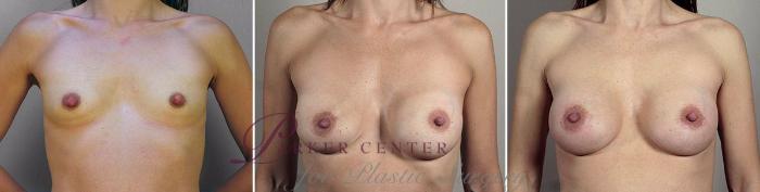 Breast Implant Revision Case 604 Before & After View #3 | Paramus, NJ | Parker Center for Plastic Surgery