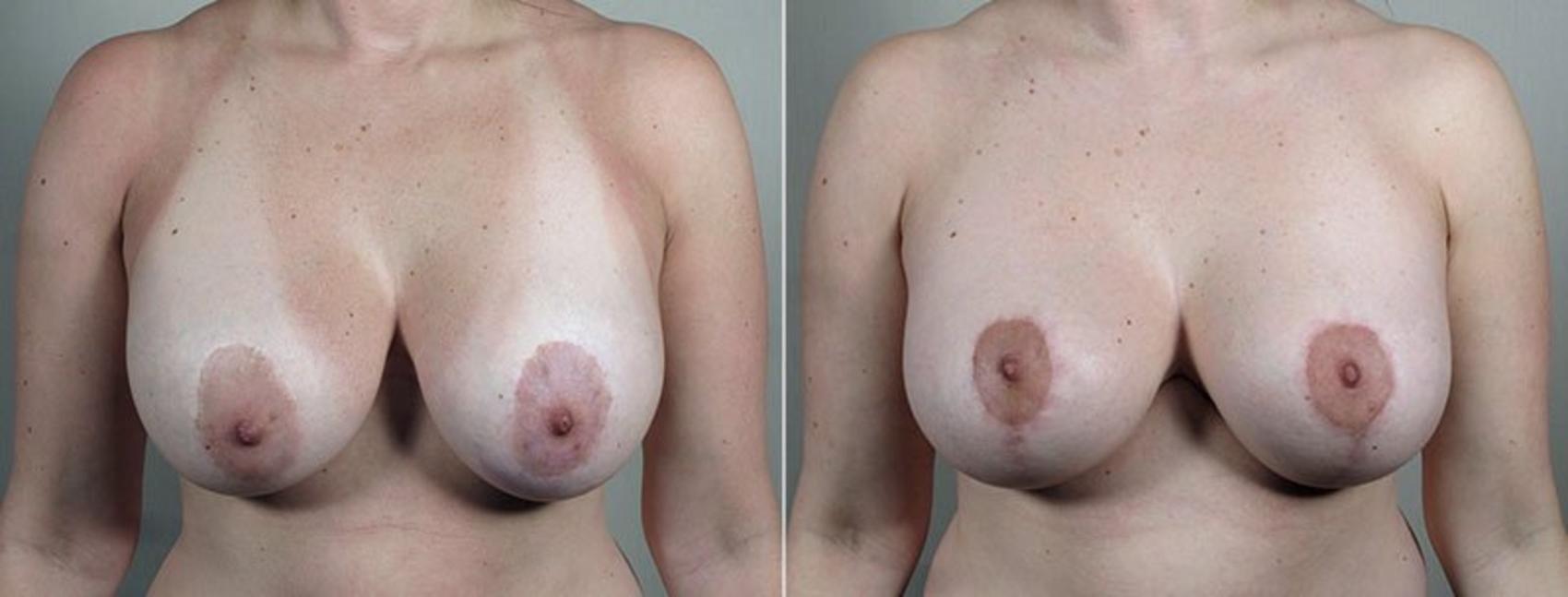 Breast Implant Revision Case 605 Before & After View #1 | Paramus, NJ | Parker Center for Plastic Surgery