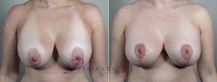 Breast Implant Revision Case 605 Before & After View #1 | Paramus, NJ | Parker Center for Plastic Surgery