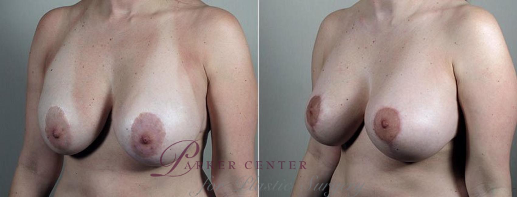 Breast Implant Revision Case 605 Before & After View #2 | Paramus, NJ | Parker Center for Plastic Surgery