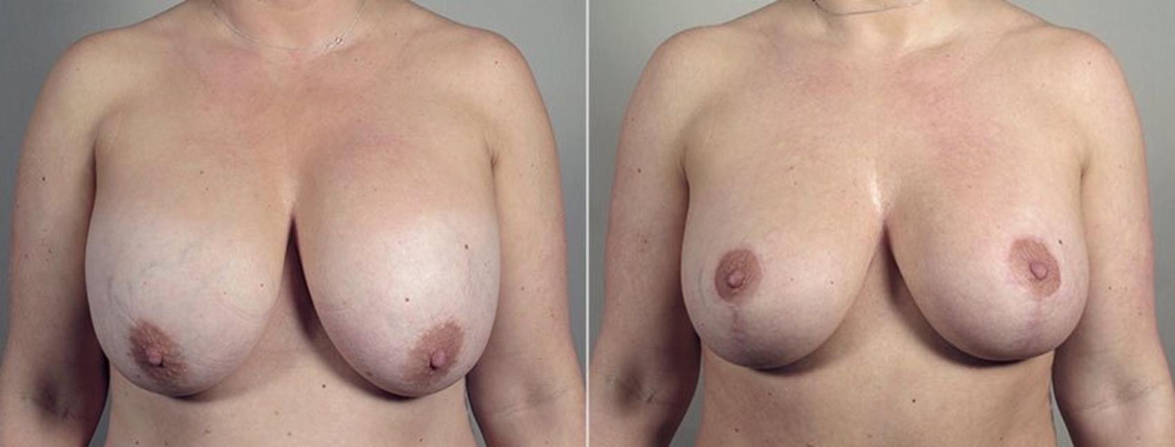 Breast Implant Revision Case 606 Before & After View #1 | Paramus, New Jersey | Parker Center for Plastic Surgery