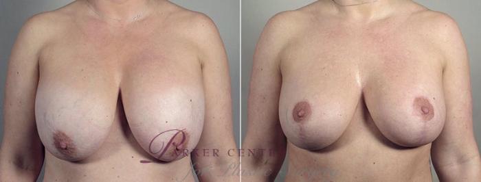 Breast Implant Revision Case 606 Before & After View #1 | Paramus, NJ | Parker Center for Plastic Surgery