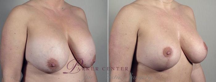 Breast Implant Revision Case 606 Before & After View #2 | Paramus, NJ | Parker Center for Plastic Surgery